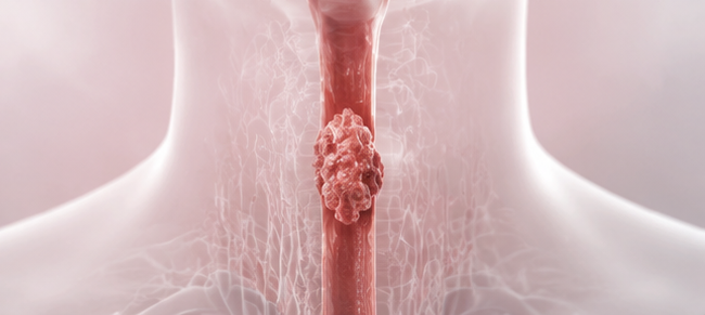 esophageal