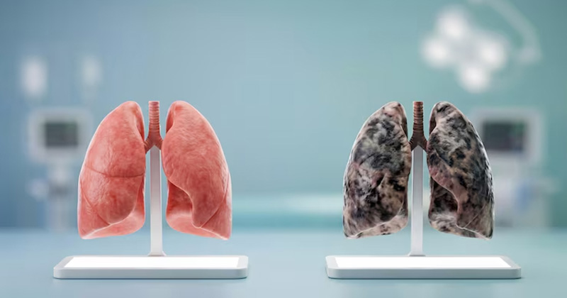 lung cancer image