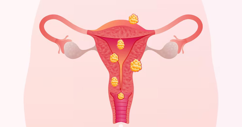 cervical cancer image