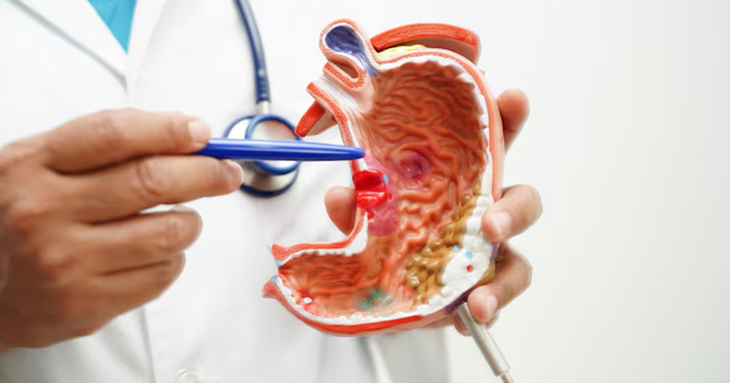 stomach cancer image