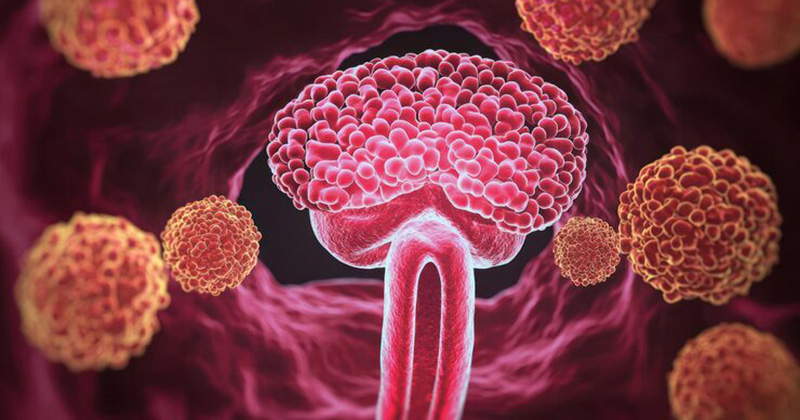 prostate cancer image