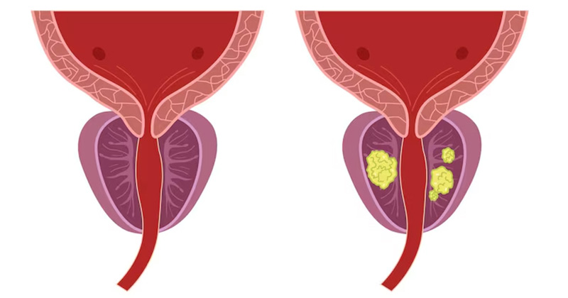 prostate cancer image